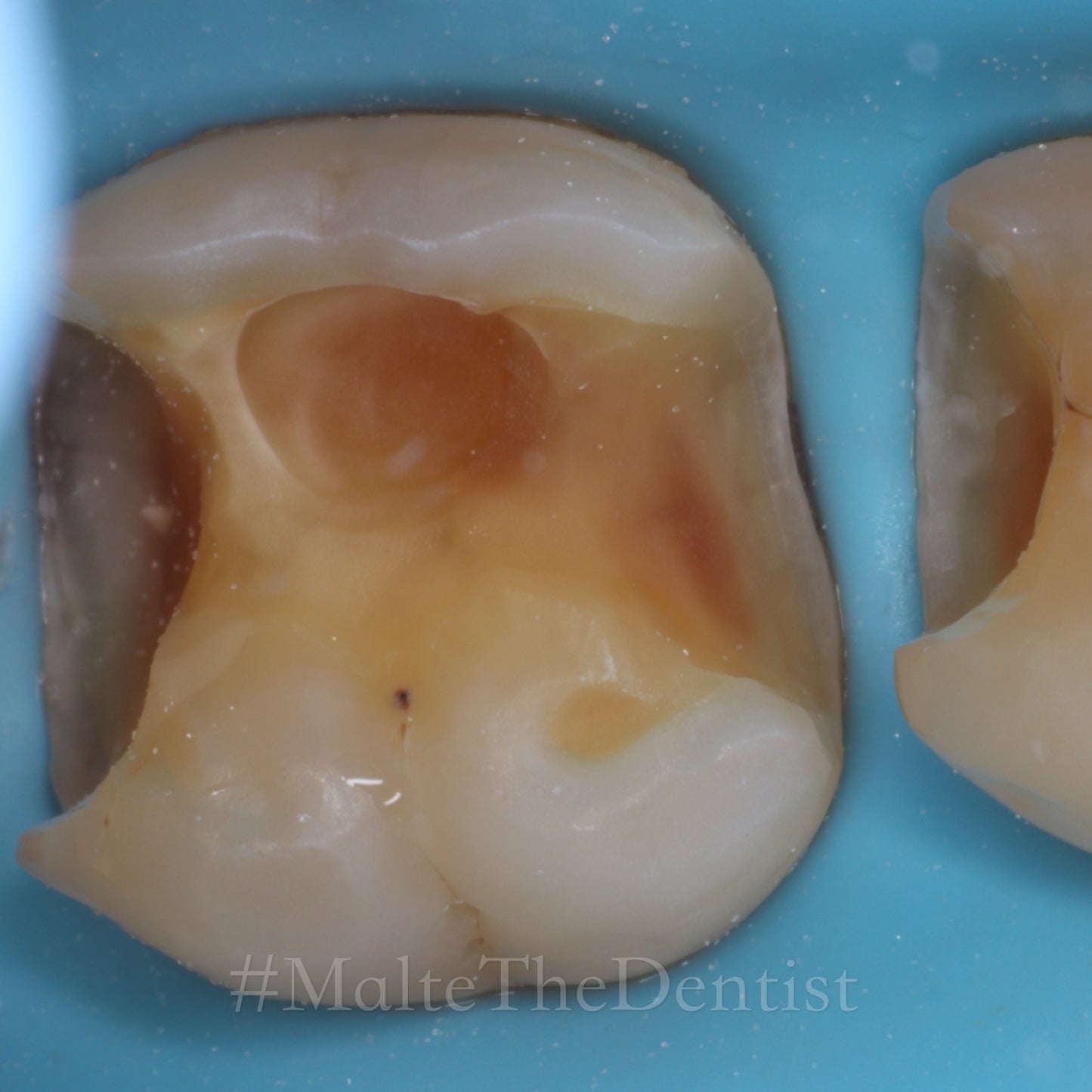 Comprehensive Composite - 2 dages hands on kursus
