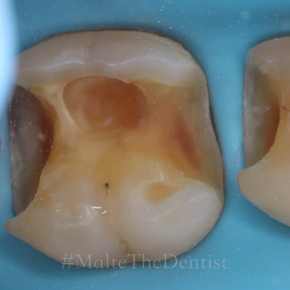 Comprehensive Composite - 2 dages hands on kursus