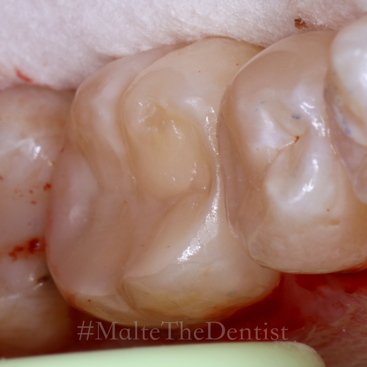 Comprehensive Composite - 2 dages hands on kursus