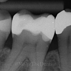 Comprehensive Composite - 2 dages hands on kursus