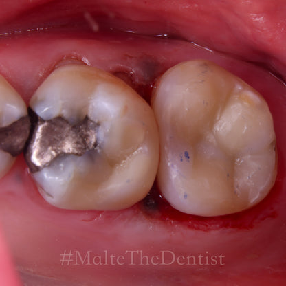 Comprehensive Composite - 2 dages hands on kursus