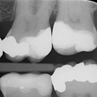 Comprehensive Composite - 2 dages hands on kursus
